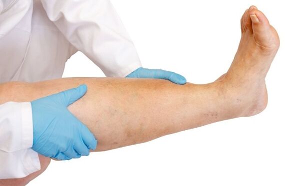 Leg swelling
