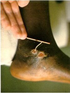 Guinea worm extracted from the leg of a person suffering from dracunculiasis