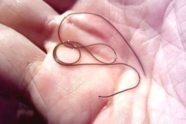 worm parasite from the human body