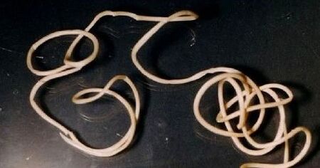 Guinea worm